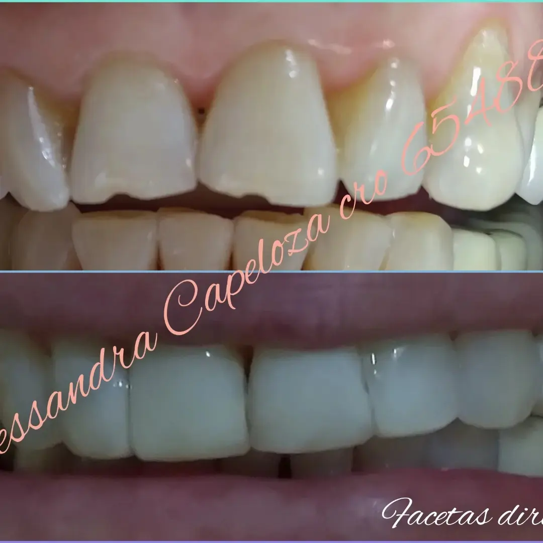 Reconstrução Estética (antes e depois)